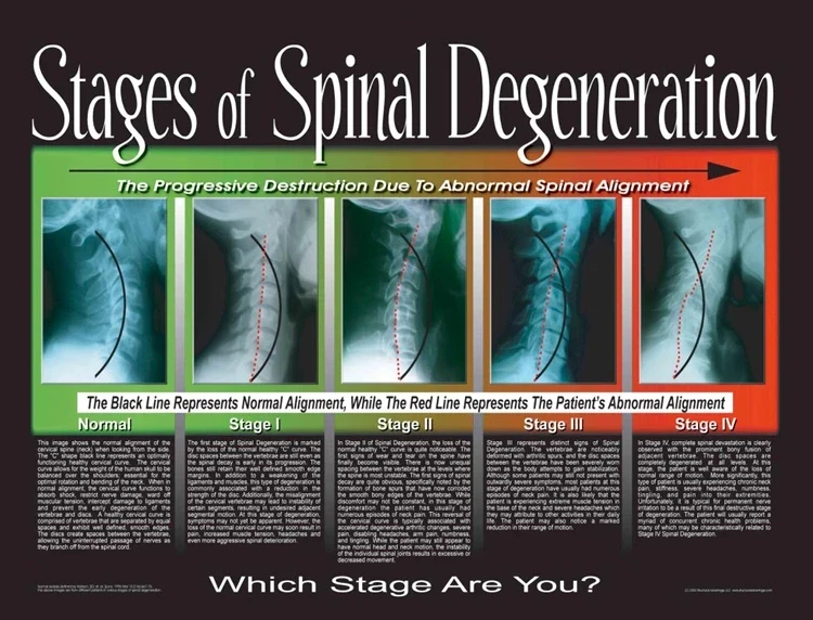 Chiropractic Auburn WA Spinal Degeneration Stages